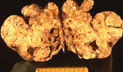 2014-05-04_ovarian_cancer